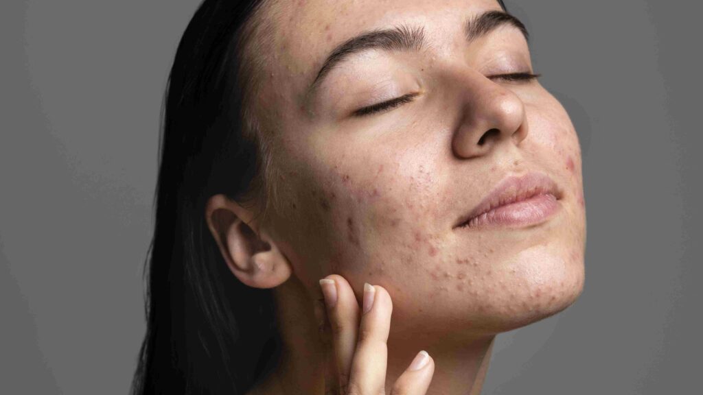 acne injection. treatment jerawat meradang. suntik jerawat. cara menghilangkan jerawat meradang. acne injection adalah. cara menghilangkan jerawat. jerawat cystic. jerawat besar sakit. klinik jerawat jakarta. perawatan jerawat dokter. suntik jerawat apakah aman.