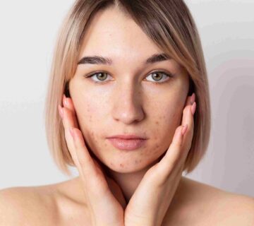 makanan harus dihindari saat breakout